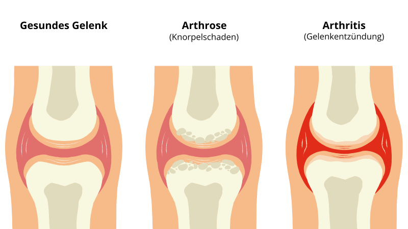 Darstellung Arthrose und Arthritis