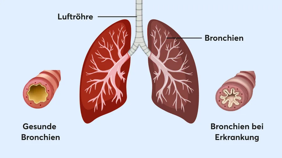 Grafik: Luftröhre, Bronchien, gesunde Bronchien und Bronchien bei Erkrankung
